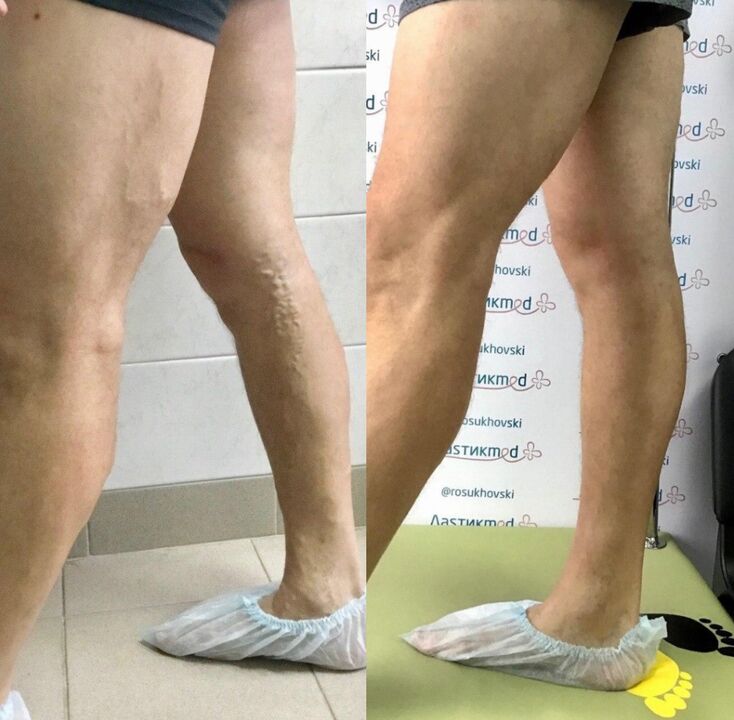 Εμπειρία χρήσης vasaxal